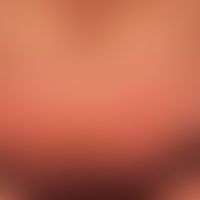 Pemphigoid bullöses: nahezu erythrodermisches Krankheitsbild mit flächigen, urtikariellen, erhebl...