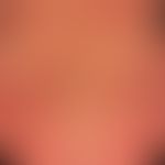 Pemphigoid bullöses: nahezu erythrodermisches Krankheitsbild mit flächigen, urtikariellen, erhebl...