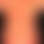 Pemphigoid bullöses: nahezu erythrodermisches Krankheitsbild mit flächigen, urtikariellen, erhebl...