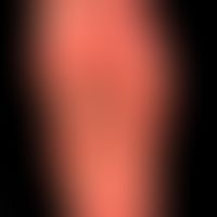 Pemphigoiderkrankungen: dyshidrotisches Erscheinungsbild bei generalisiertem, nahezu erfxythroder...