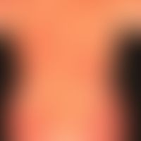 Pemphigoiderkrankungen: schwer verlaufendes nahezu erythrodermisches bullöses Pemphigoid.&nbsp;
