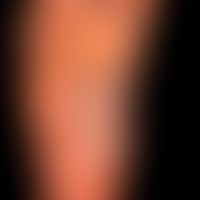 Dyshidrotische Dermatitis: ausgehend von einem längerzeitig besteheden,&nbsp;gramnegativen&nbsp;F...