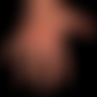 Dyshidrotische Dermatitis: ausgehend von einem längerzeitig besteheden,&nbsp;gramnegativen&nbsp;F...