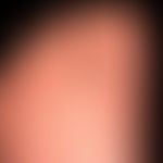 Dyshidrotische Dermatitis: ausgehend von einem längerzeitig besteheden,&nbsp;gramnegativen&nbsp;F...