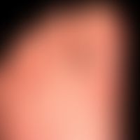 Dyshidrotische Dermatitis: ausgehend von einem längerzeitig besteheden,&nbsp;gramnegativen&nbsp;F...