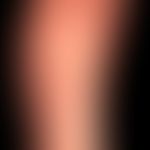 Dyshidrotische Dermatitis: ausgehend von einem längerzeitig besteheden,&nbsp;gramnegativen&nbsp;F...