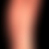 Dyshidrotische Dermatitis: ausgehend von einem längerzeitig besteheden,&nbsp;gramnegativen&nbsp;F...