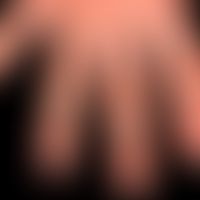 Dyshidrotische Dermatitis: ausgehend von einem längerzeitig besteheden,&nbsp;gramnegativen&nbsp;F...