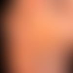 Dyshidrotische Dermatitis: ausgehend von einem längerzeitig bestehenden,&nbsp;gramnegativen&nbsp;...