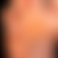 Dyshidrotische Dermatitis: ausgehend von einem längerzeitig bestehenden,&nbsp;gramnegativen&nbsp;...
