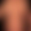 Prurigo nodularis: chronisch aktives, seit&nbsp;Jahren persistierendes&nbsp;Krankheitsbild. Gener...