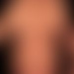 Prurigo nodularis: chronisch aktives, seit&nbsp;Jahren persistierendes&nbsp;Krankheitsbild. Gener...