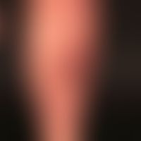 Prurigo nodularis: chronisch aktives, seit&nbsp;Jahren persistierendes&nbsp;Krankheitsbild. Gener...