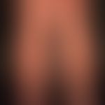 Prurigo nodularis: chronisch aktives, seit&nbsp;Jahren persistierendes&nbsp;Krankheitsbild. Gener...