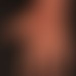 Prurigo nodularis: chronisch aktives, seit&nbsp;Jahren persistierendes&nbsp;Krankheitsbild. Gener...