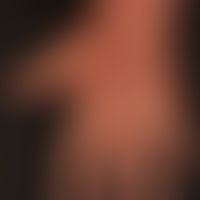 Prurigo nodularis: chronisch aktives, seit&nbsp;Jahren persistierendes&nbsp;Krankheitsbild. Gener...