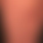 Prurigo nodularis: chronisch aktives, seit&nbsp;Jahren persistierendes&nbsp;Krankheitsbild. Gener...