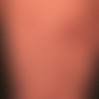 Prurigo nodularis: chronisch aktives, seit&nbsp;Jahren persistierendes&nbsp;Krankheitsbild. Gener...
