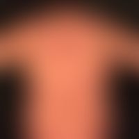 Prurigo nodularis: chronisch aktives, seit&nbsp;Jahren persistierendes&nbsp;Krankheitsbild. Gener...