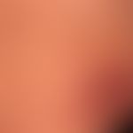 Prurigo nodularis: chronisch aktives, seit&nbsp;Jahren persistierendes&nbsp;Krankheitsbild. Gener...