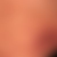 Prurigo nodularis: chronisch aktives, seit&nbsp;Jahren persistierendes&nbsp;Krankheitsbild. Gener...