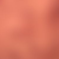 Prurigo nodularis: chronisch aktives, seit&nbsp;Jahren persistierendes&nbsp;Krankheitsbild. Gener...