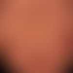 Prurigo nodularis: chronisch aktives, seit&nbsp;Jahren persistierendes&nbsp;Krankheitsbild. Gener...