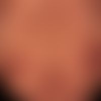Prurigo nodularis: chronisch aktives, seit&nbsp;Jahren persistierendes&nbsp;Krankheitsbild. Gener...