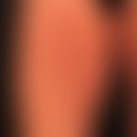 Erythema e calore: regelmäßige Anwendungen von Wärmekissen bei chronischem Friefren.&nbsp;&nbsp;U...