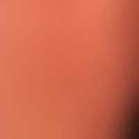 Erythema e calore: regelmäßige Anwendungen von Wärmekissen bei chronischem Friefren.&nbsp;&nbsp;U...