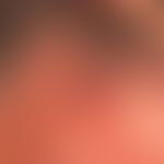 Differenzialdiagnose: Primär kutanes B-Zell-Lymphom

Diagnose:&nbsp;Granuloma faciale. Feste&nbsp...