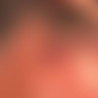 Differenzialdiagnose: Primär kutanes B-Zell-Lymphom

Diagnose:&nbsp;Granuloma faciale. Feste&nbsp...