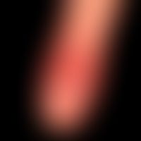 Colitis ulcerosa: chronische psoriasiforme Paronychie

