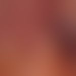Chronische mukokutane Candidiasis (Detail)&nbsp;bei generalisiertem Kaposi-Sarkom. Hier auch Befa...