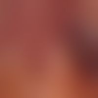 Chronische mukokutane Candidiasis (Detail)&nbsp;bei generalisiertem Kaposi-Sarkom. Hier auch Befa...