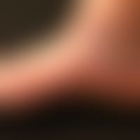 Corona phlebectatica: Ausgeprägte&nbsp;Besenreiser im Bereich von Fußseitenkante und Knöcheregion...