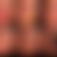 Differenzialdiagnose der Melanonychie. In Teilabbildung V&nbsp; zeigt der Pfeil auf die differenz...