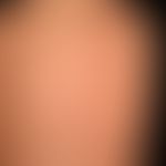 Sarkoidose der Haut:&nbsp;Kleinknotige, disseminierte Form der Sarkoidose (häufigste Form:&nbsp;G...