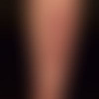 Differenzialdiagnose: Purpura jaune d'ocre

Diagnose: Vaskulitis leukozytoklastische. Ältere und ...