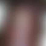 M. ulcerans/Nichttuberkulöse Mykobakteriosen: Primärinfektion der Haut durch M. ulcerans (Buruli-...