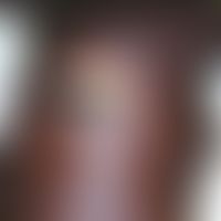 M. ulcerans/Nichttuberkulöse Mykobakteriosen: Primärinfektion der Haut durch M. ulcerans (Buruli-...