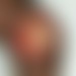 M. ulcerans/Nichttuberkulöse Mykobakteriosen: Infektion durch M. ulcerans, sog. Buruli-Ulkus; ent...