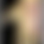 Mycobacterium marinum/Nichttuberkulöse Mykobakteriose: seit Jahren bestehende und unbehandelte, g...