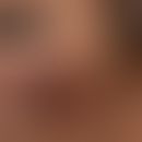 Mycobacterium smegmatis: abszedierende Inflammation der Gesichtshaut nach Applikation von Fillerm...