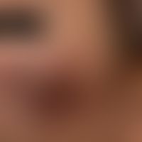 M. smegmatis/Nichttuberkulöse Mykobakteriosen: flächige granulomatöse Inflammation der Wangenregi...