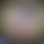 Mycobacterium intermedium: abszedierende Inflammation einer Bilddarmnarbe. Nosokomiale Mischinfek...