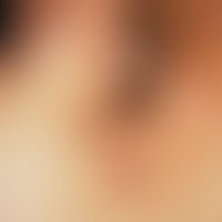 Differenzialdiagnose:&nbsp;Hidradenitis suppurativa

Diagnose: Tuberculosis cutis colliquativa (S...