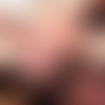 Kutaner mykobakterieller Spindelzellpseudotumor: schmerzlose knotige Läsionen bei einem immunsupp...