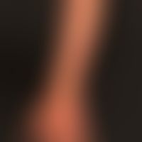 Differenzialdaignose:&nbsp;Sporotrichose

Diagnose: Nichttuberkulöse Mykobakteriose (M. fortuitum)
