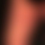 Differenzialdiagnose:&nbsp;Tinea inguinalis

Diagnose: Erythema chronicum migrans; reaktionlose R...